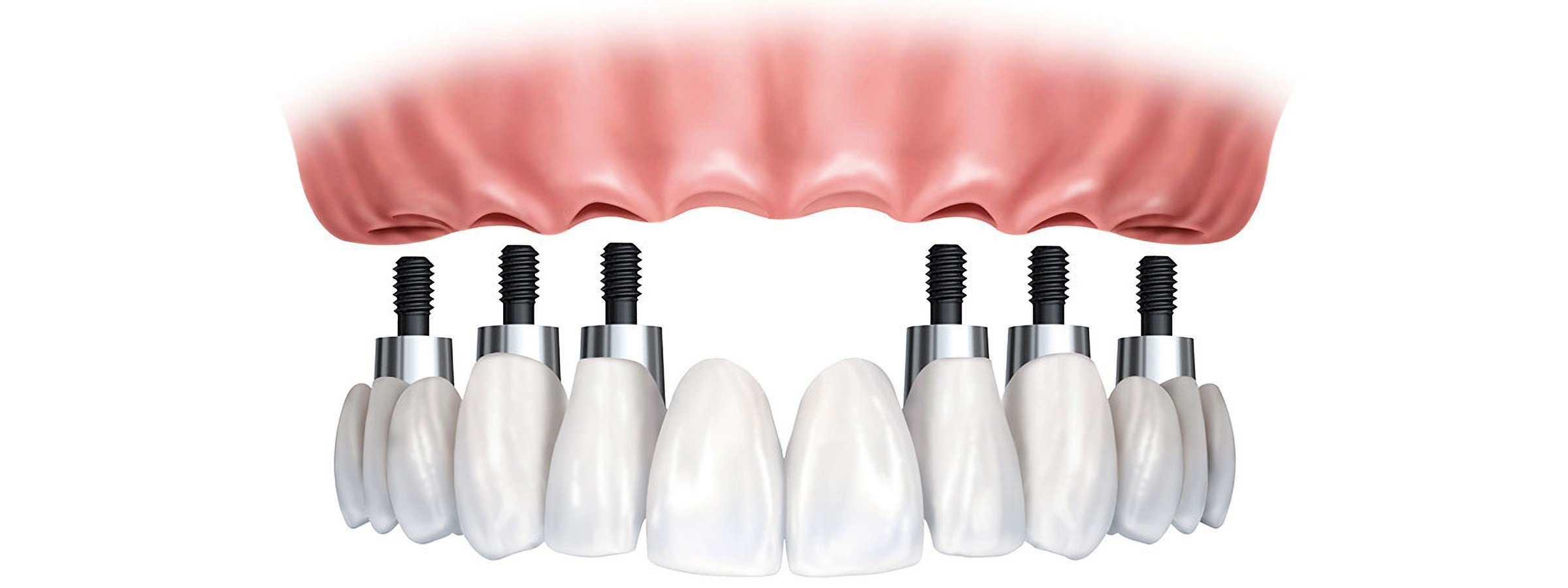Getting dental implants in Turkey