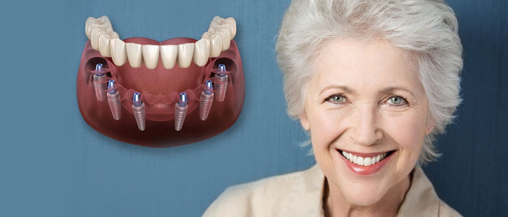 Dental implants for foreigners in Turkey