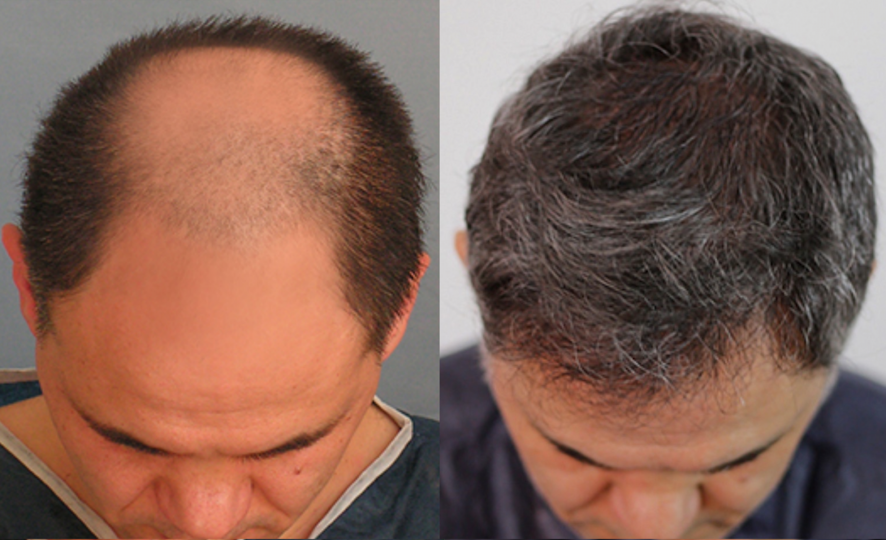 Hair transplantation for a man on the forehead