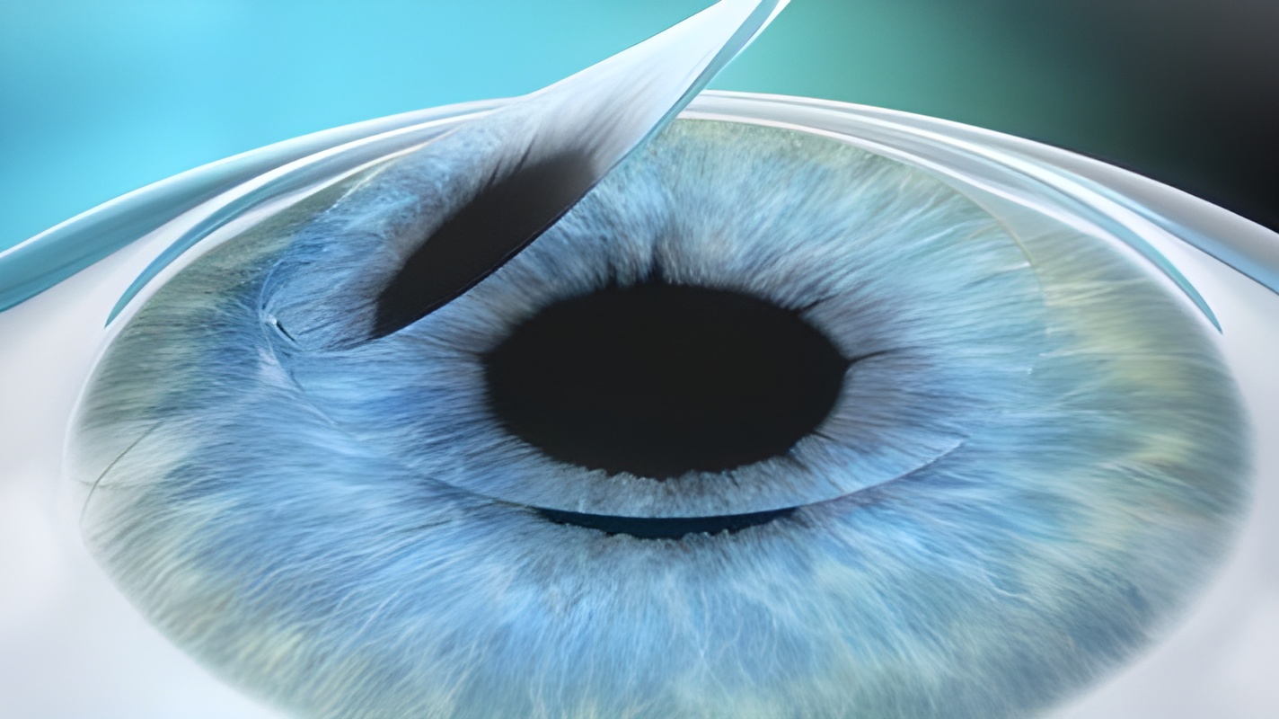 Schematic representation of the eye during Lasik surgery