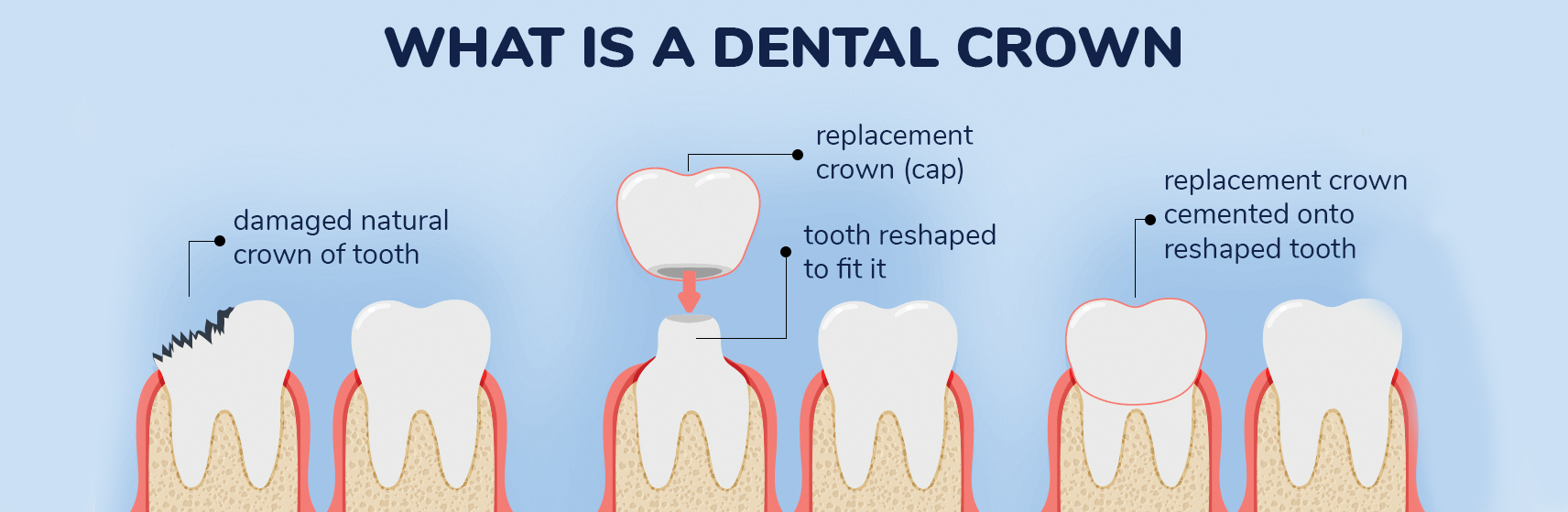 The Process of Getting Dental Crowns in Kharkiv