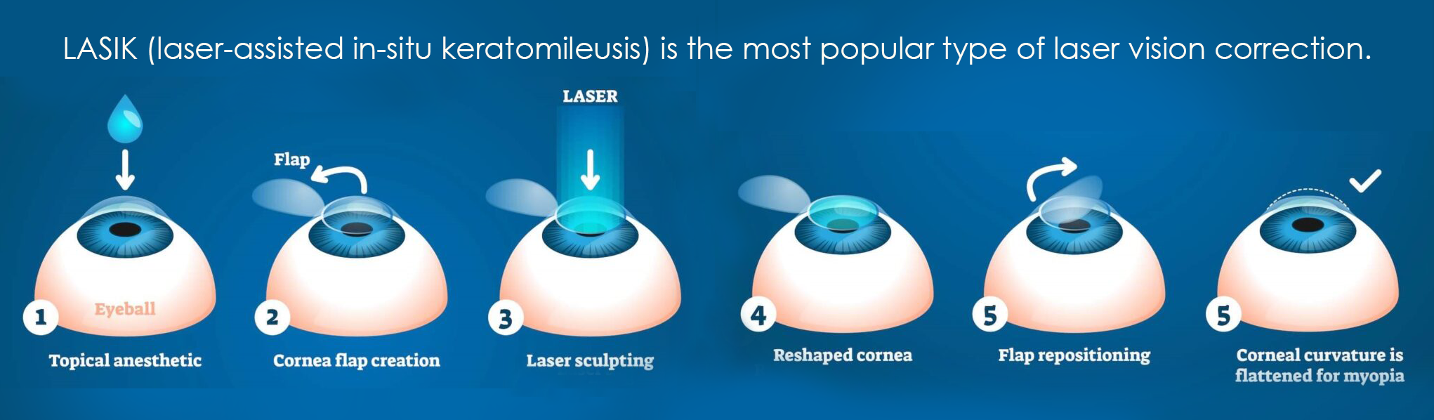 The Procedure of Laser Vision Correction in Kyiv
