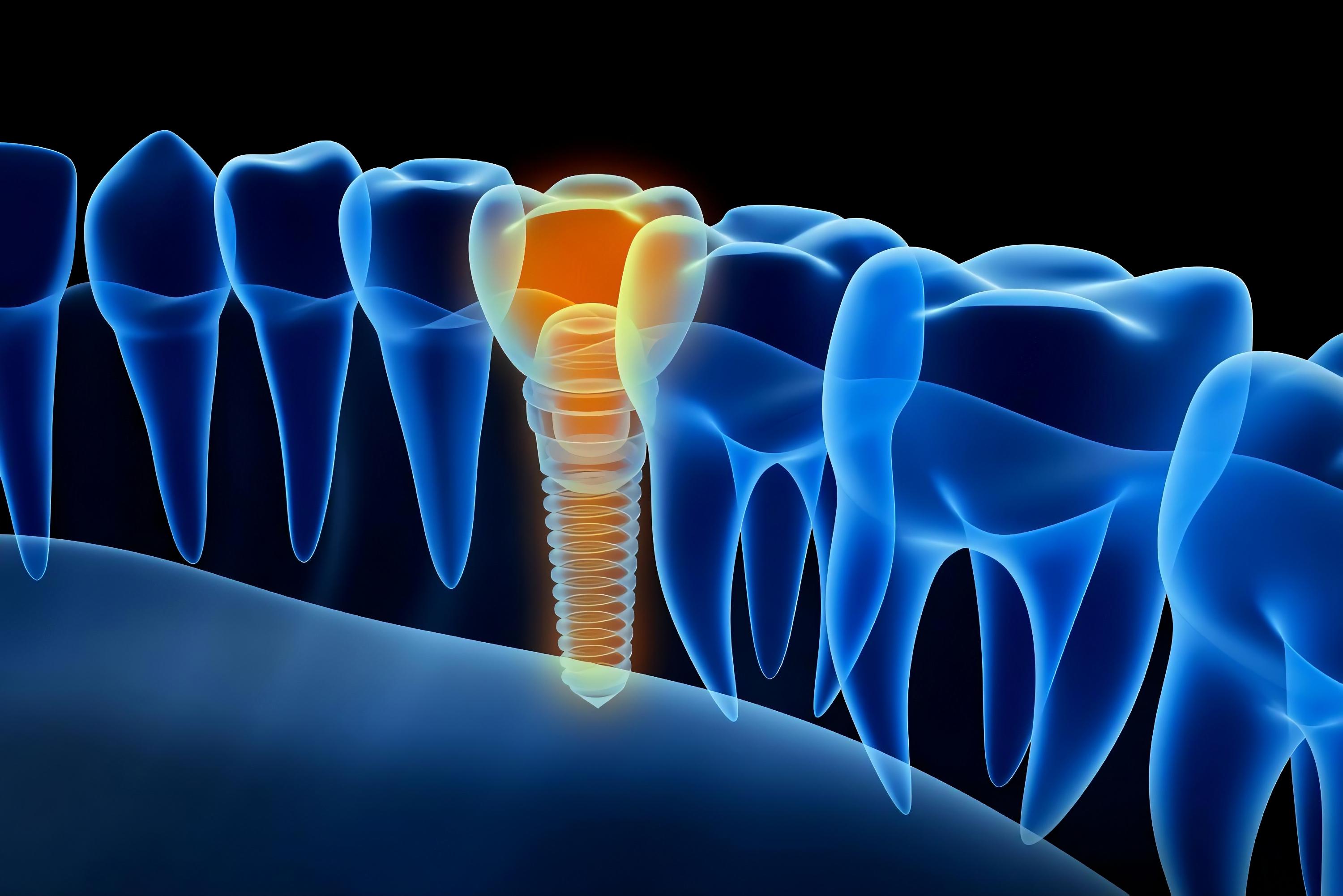Osteoporosis and dental implants