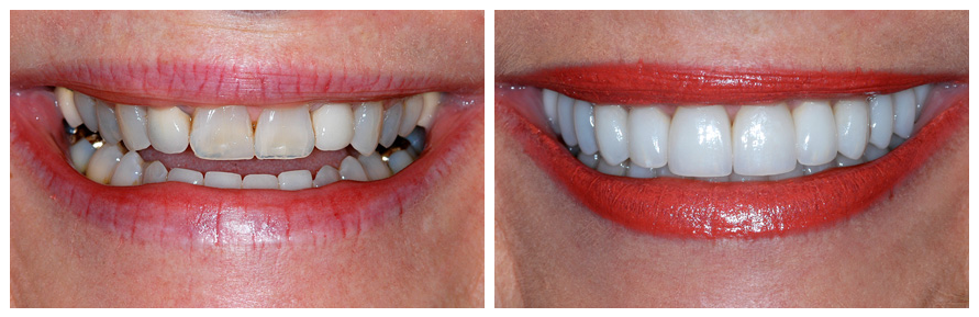 smile with emax dental crowns: before and after