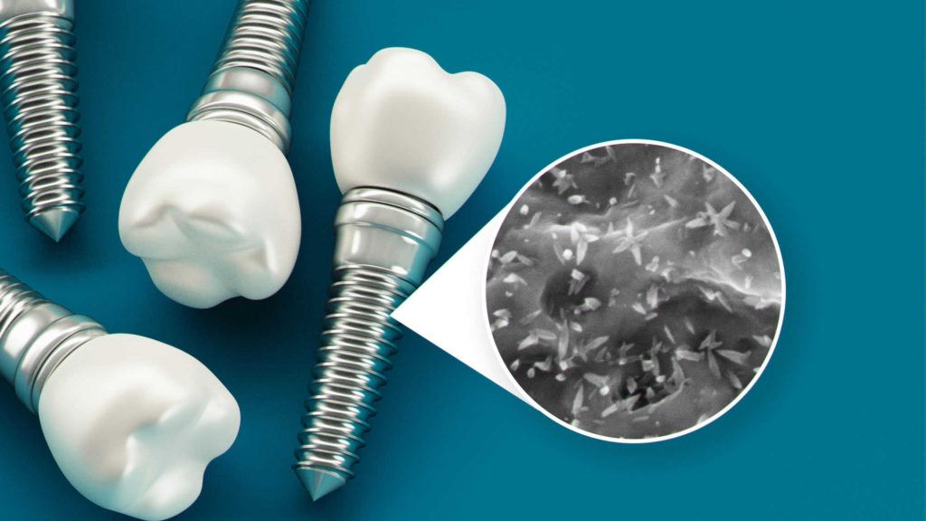 dental implants nanostructured
