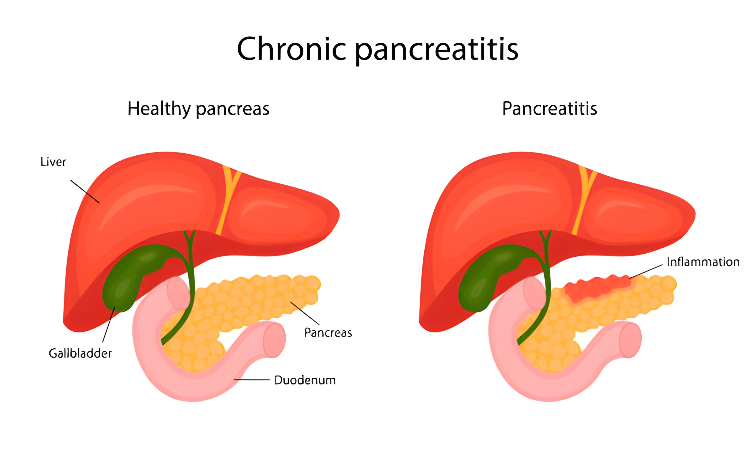  What are the symptoms of chronic pancreatitis?