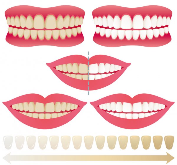 color scale for teeth whitening