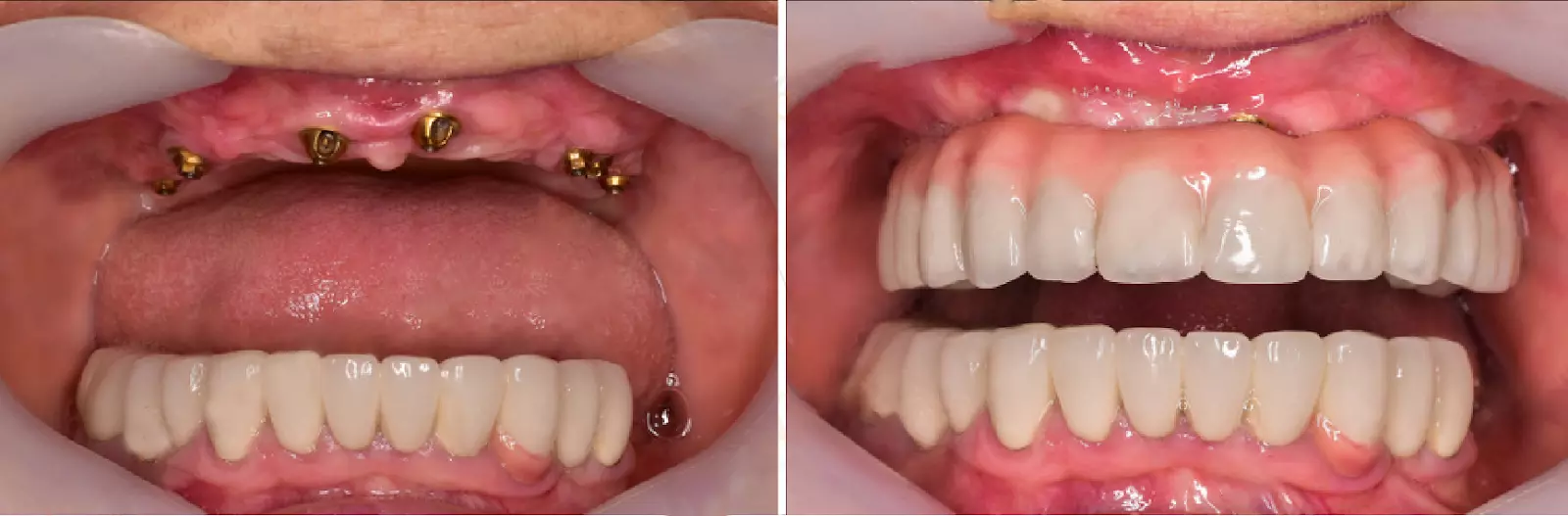All on 6 dental implants in Turkey