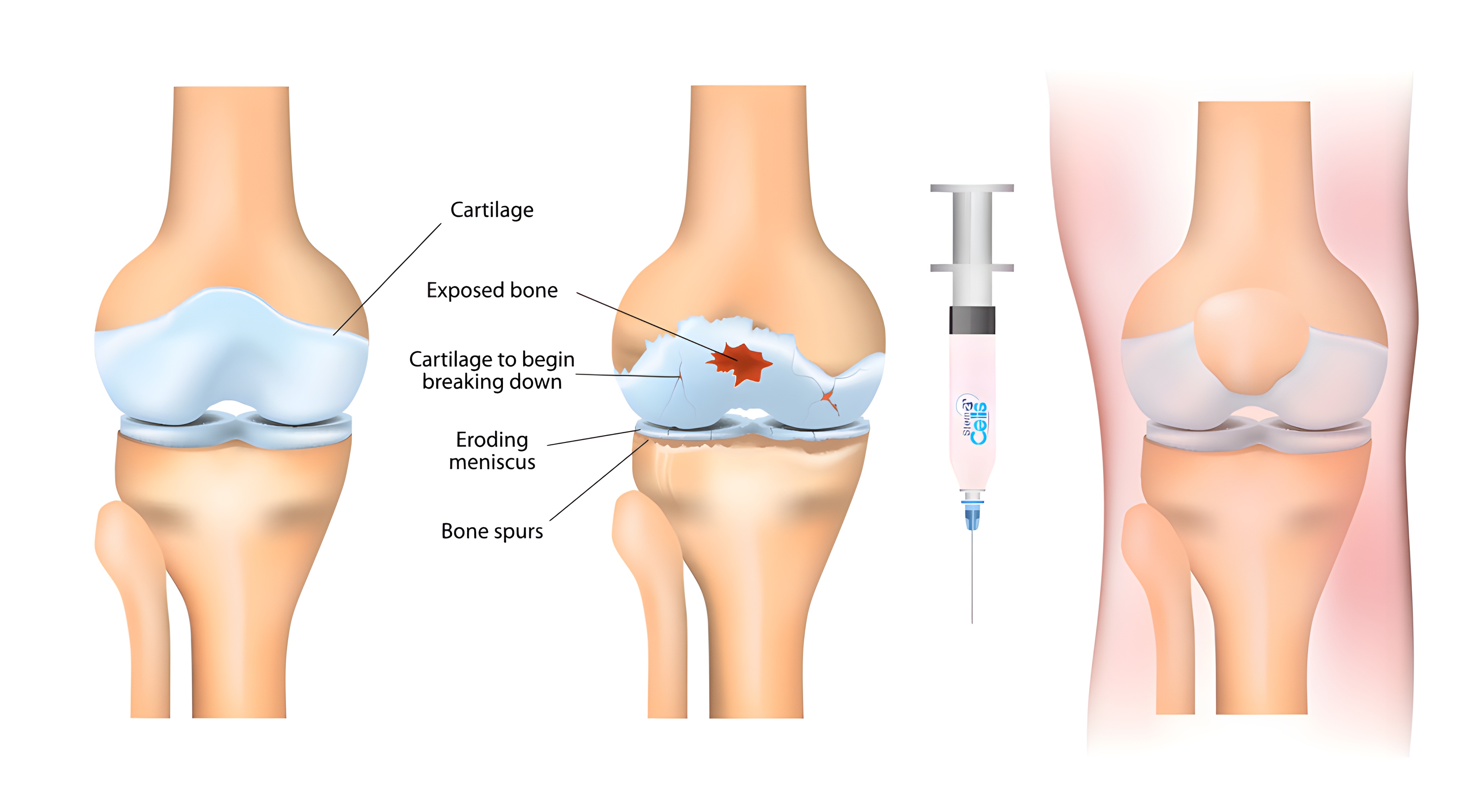 injection of mesenchymal stem cells into the knee joint for osteoarthritis