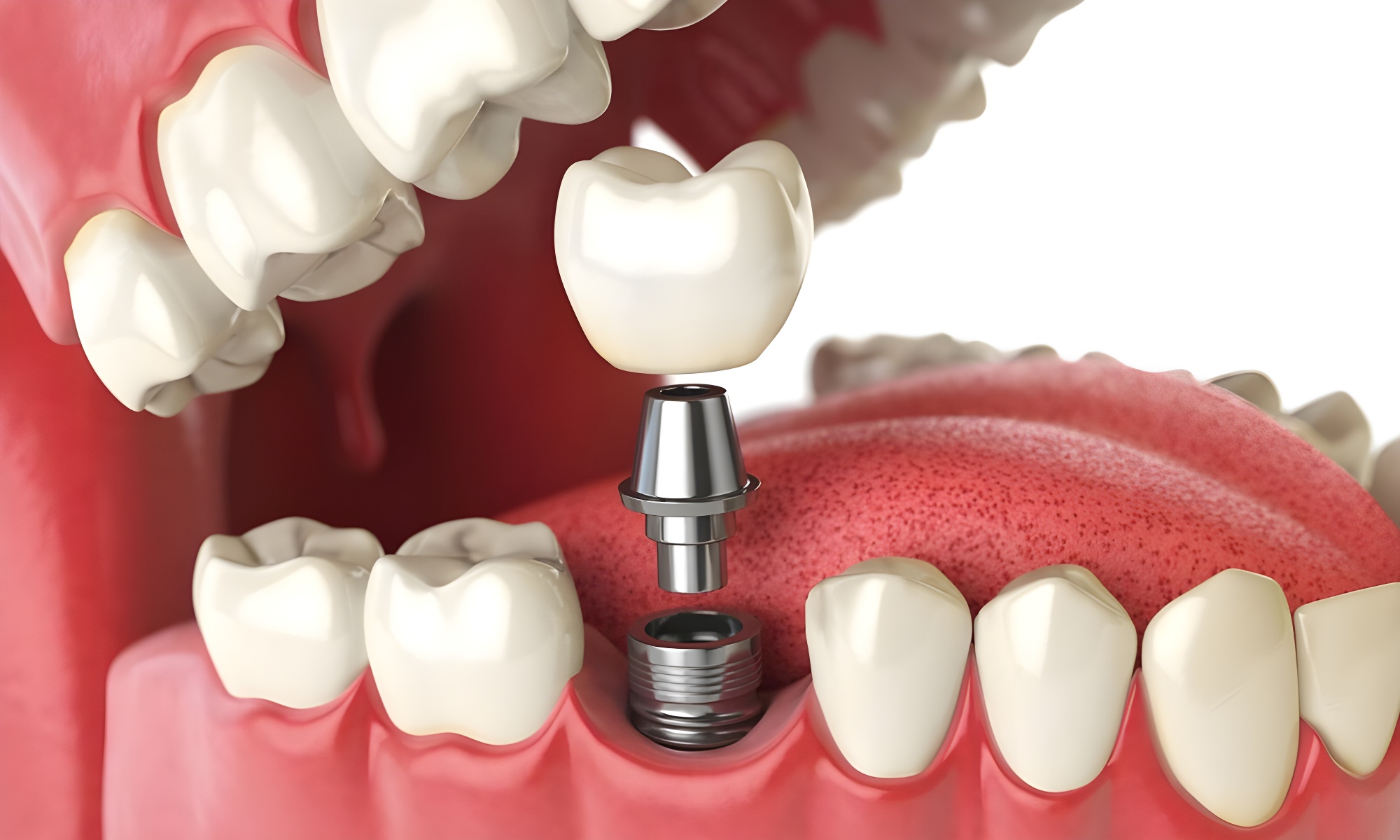infographic on how a dental implant is placed in turkey