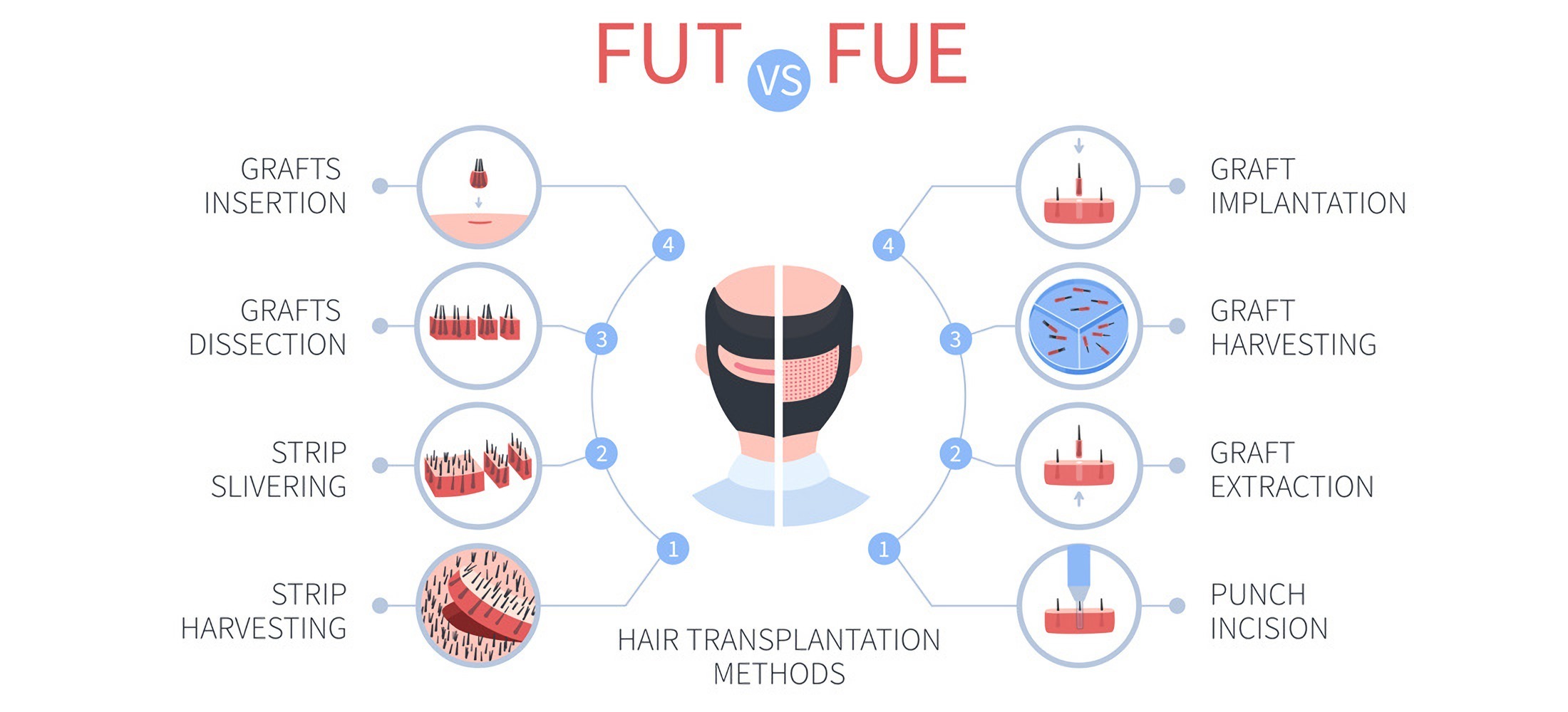 Methods of hair transplantation