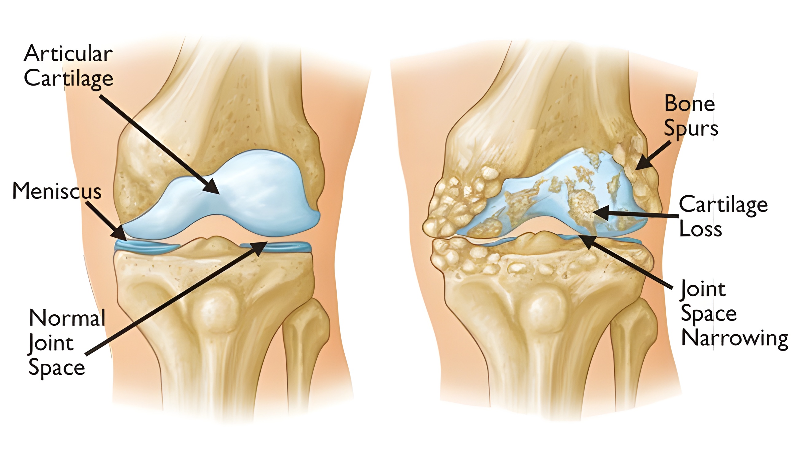 Schematic representation of a diseased and a healthy knee joint