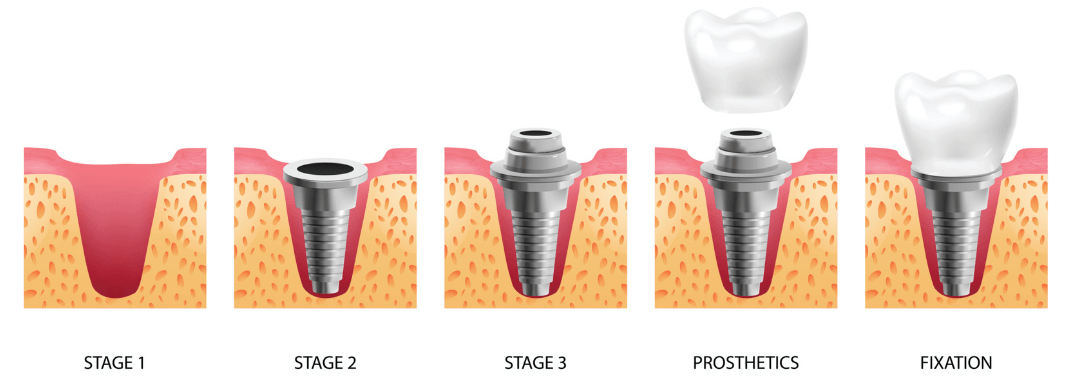 Stages of dental implant placement in Lviv