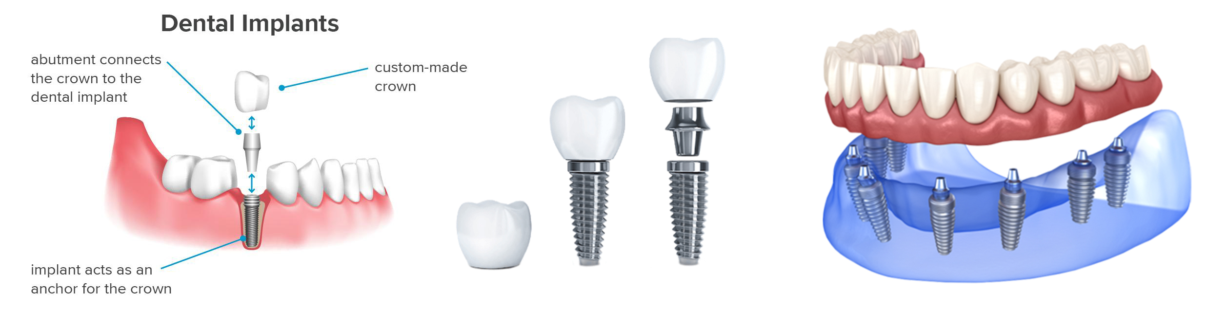 What is All-on-6 Dental Implant in Lviv