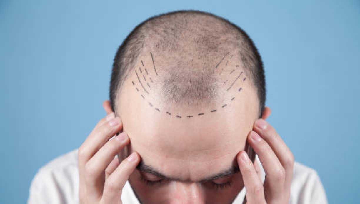 Hair transplant on bald spots in Istanbul