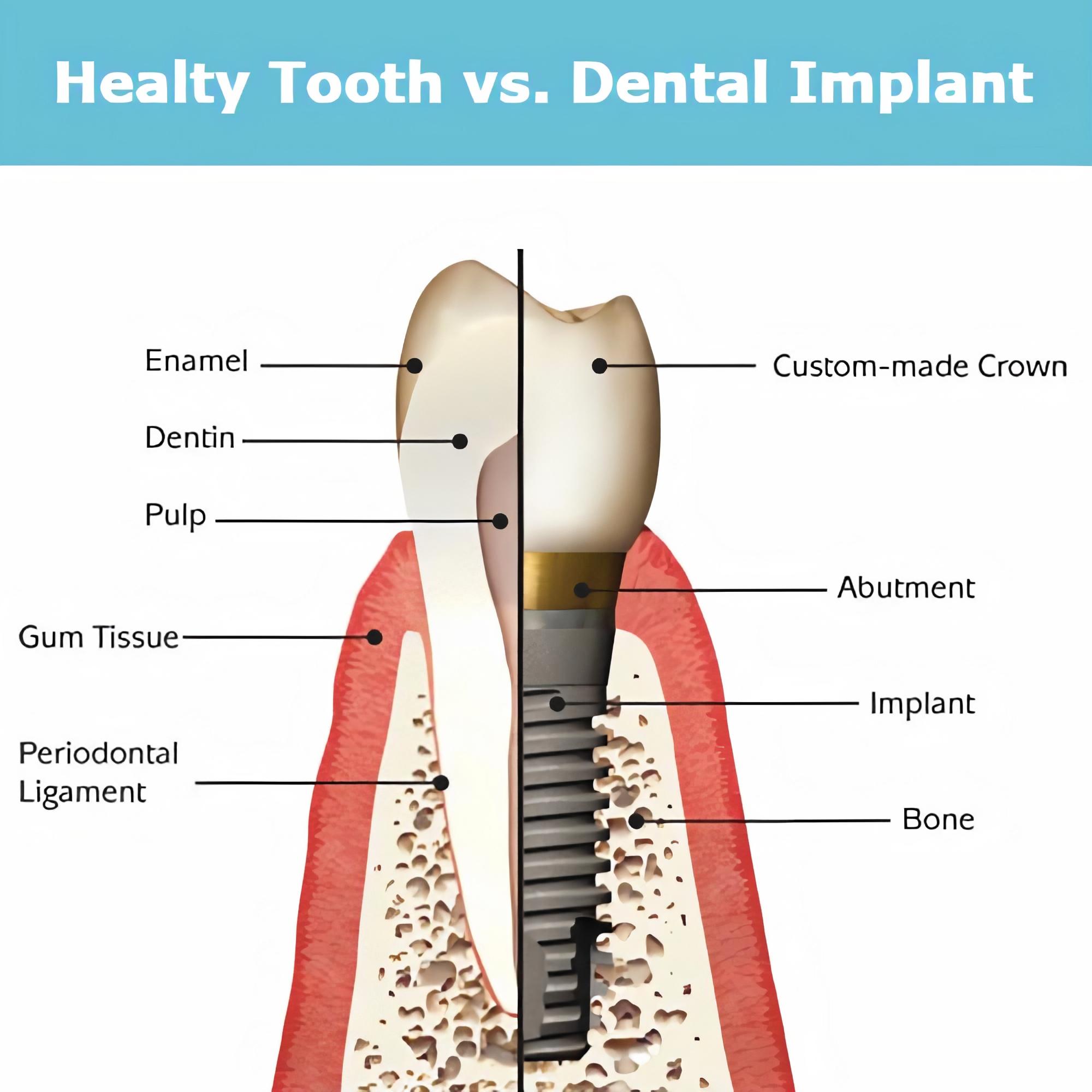 healthy teeth vs implants