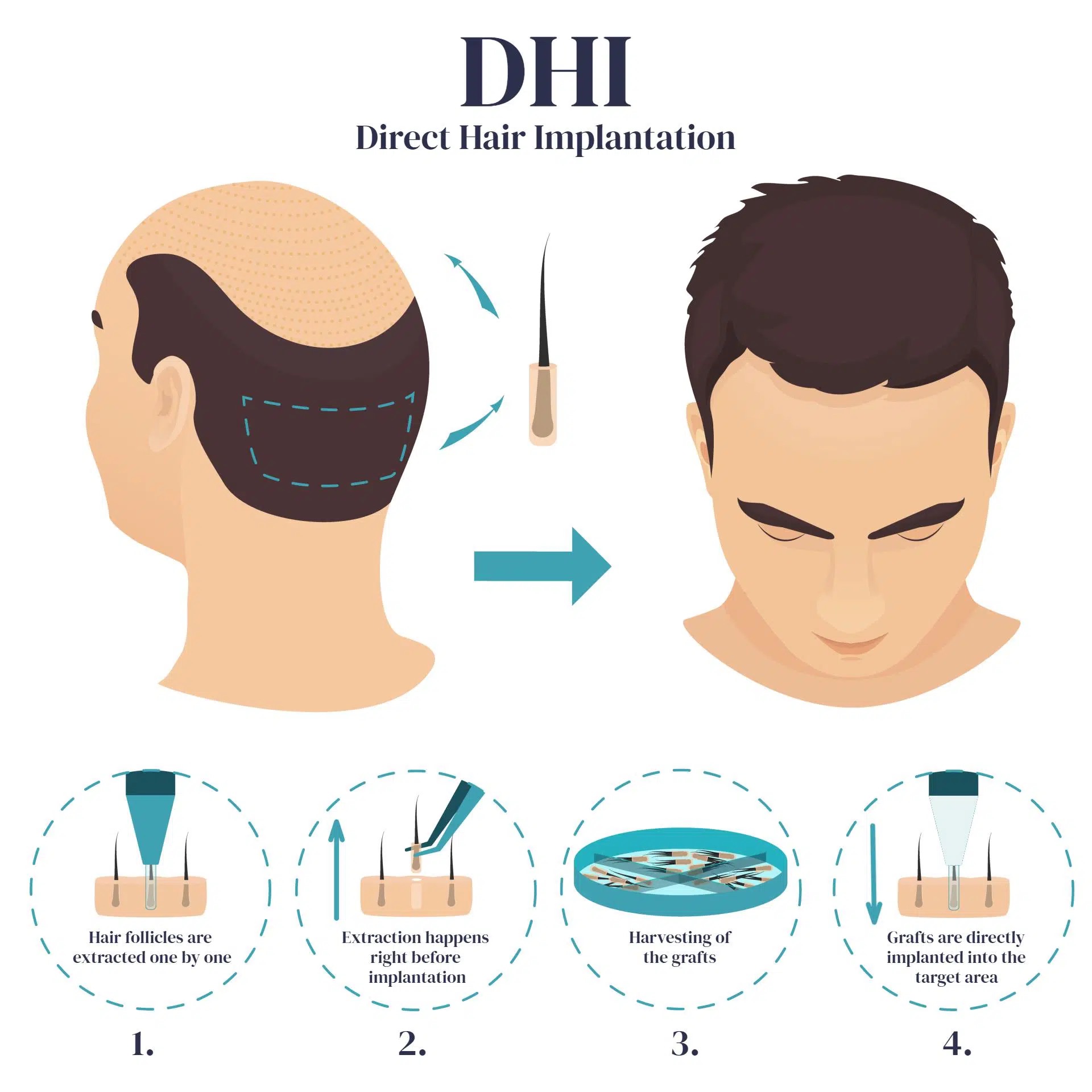 DHI Hair Transplantation in Turkey