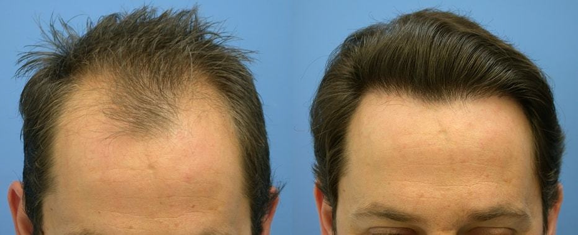 Before and After Hair Transplant in Istanbul