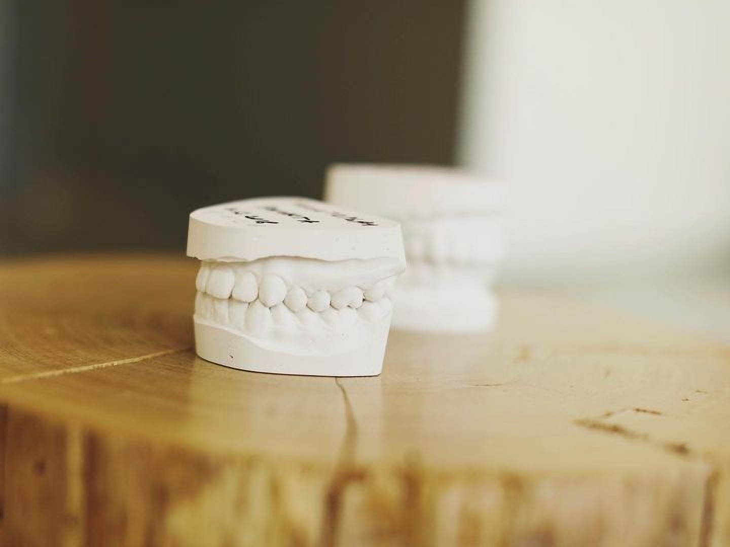 Teeth cast at Silk Dentistry Kharkov Ukraine