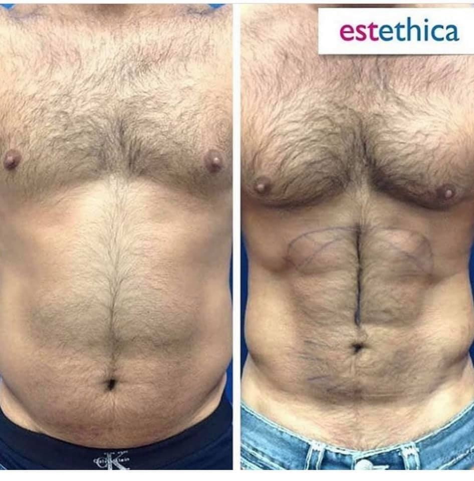 Liposuction in Istanbul at Estethica Clinic