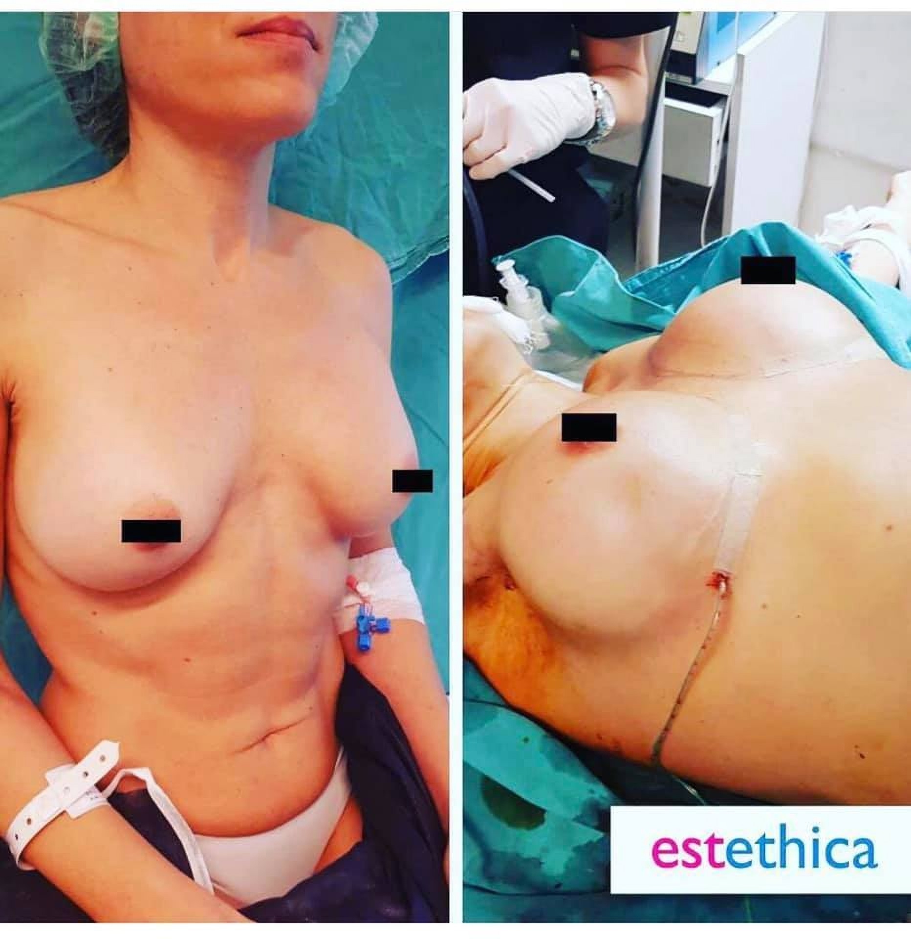 Breast augmentation in Istanbul at Estethica Clinic
