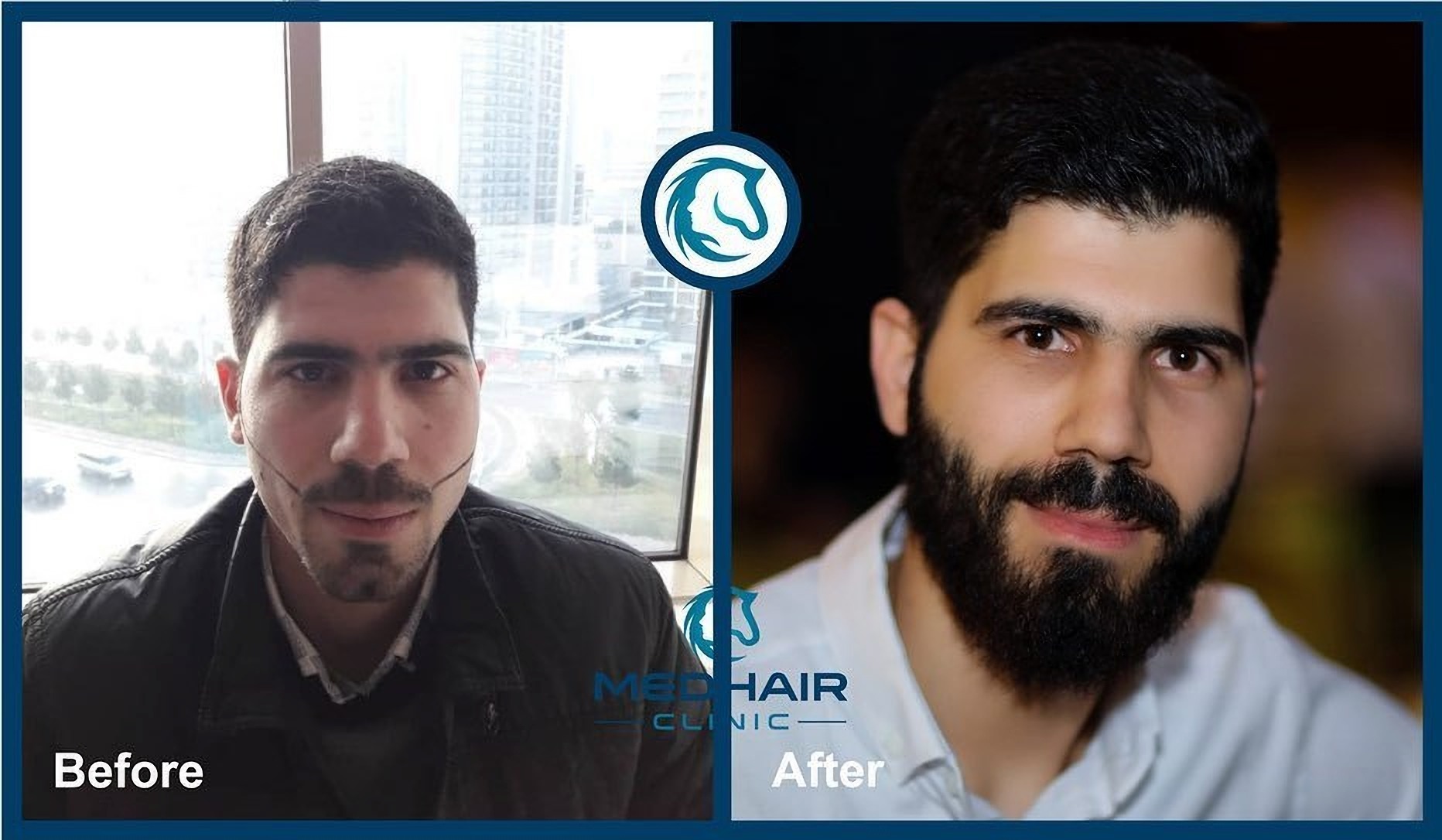 Beard hair transplantation before and after