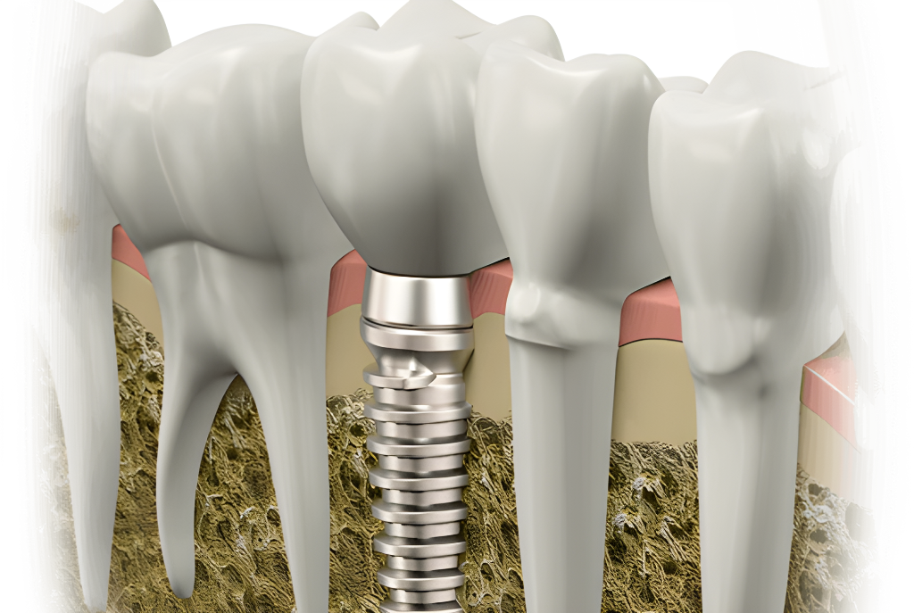 Israeli dental implants
