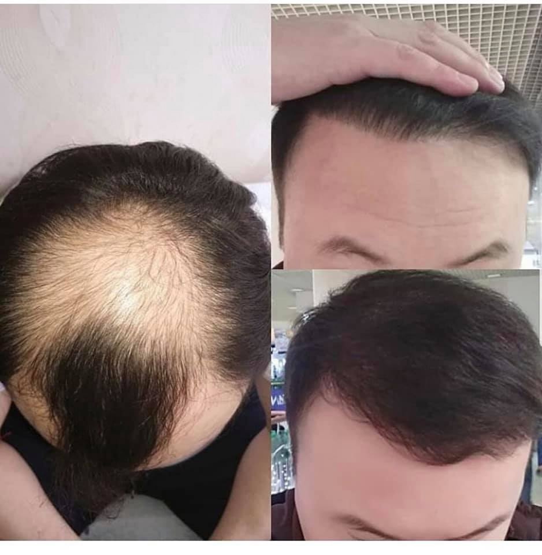 Before and after hair transplantation in Istanbul at Estethica Clinic