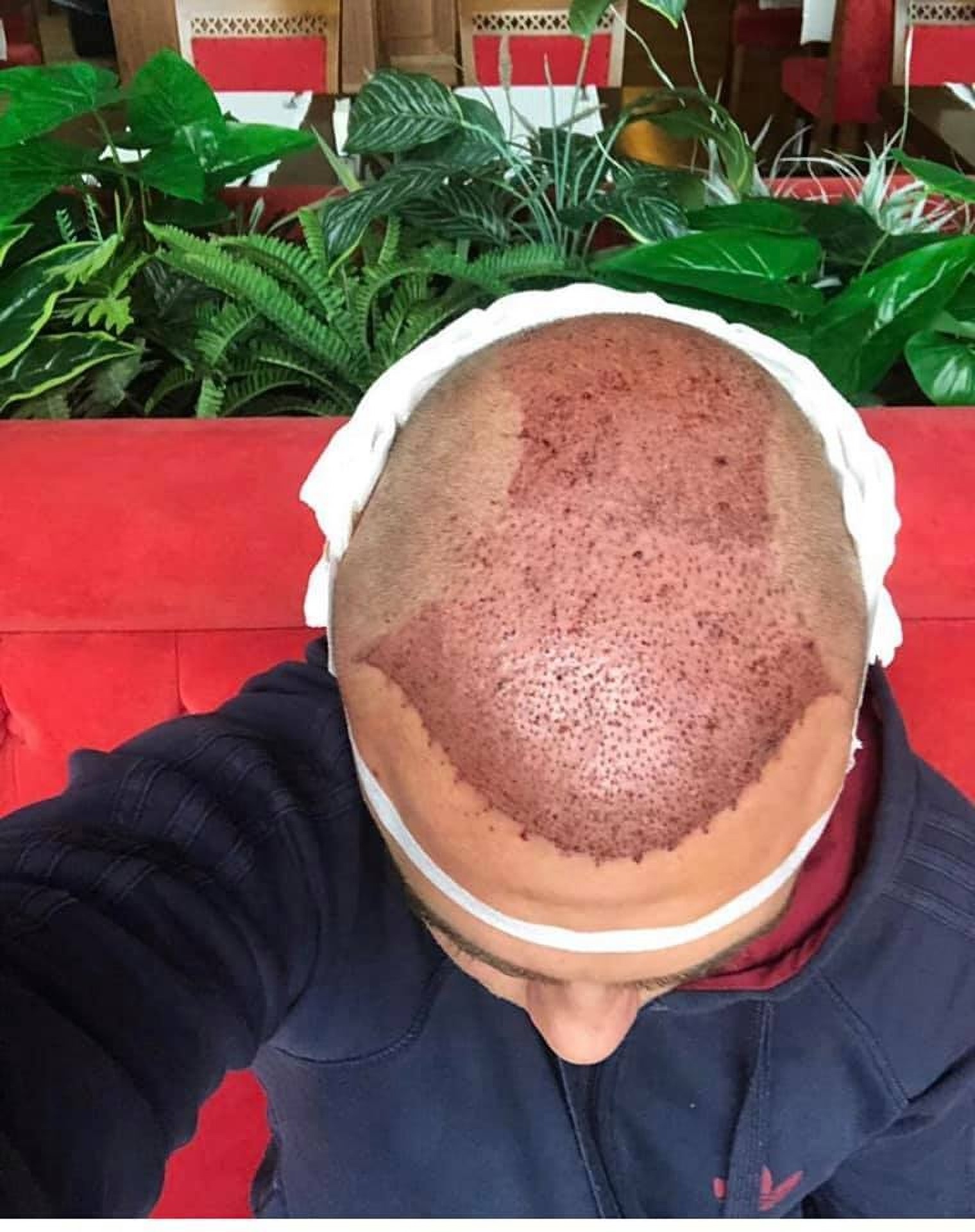 FUE Hair Transplant in Istanbul at Estethica Clinic