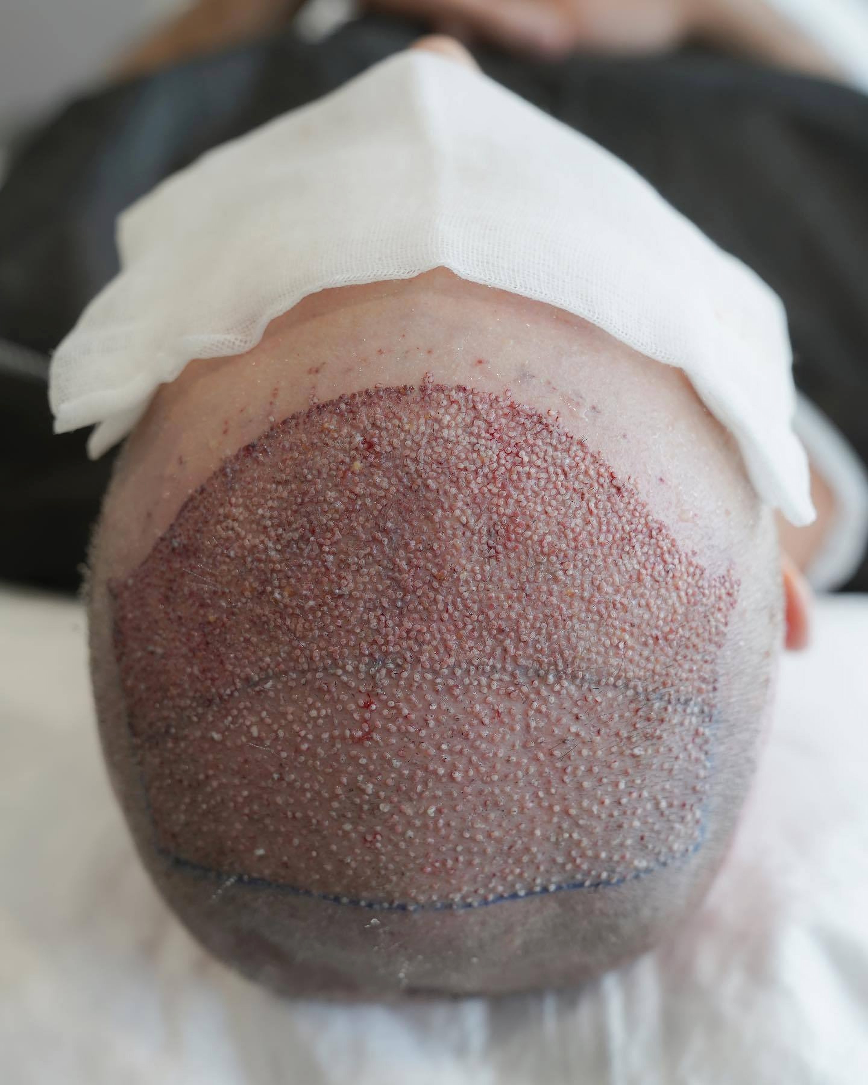 Scalp after a hair transplant in Turkey