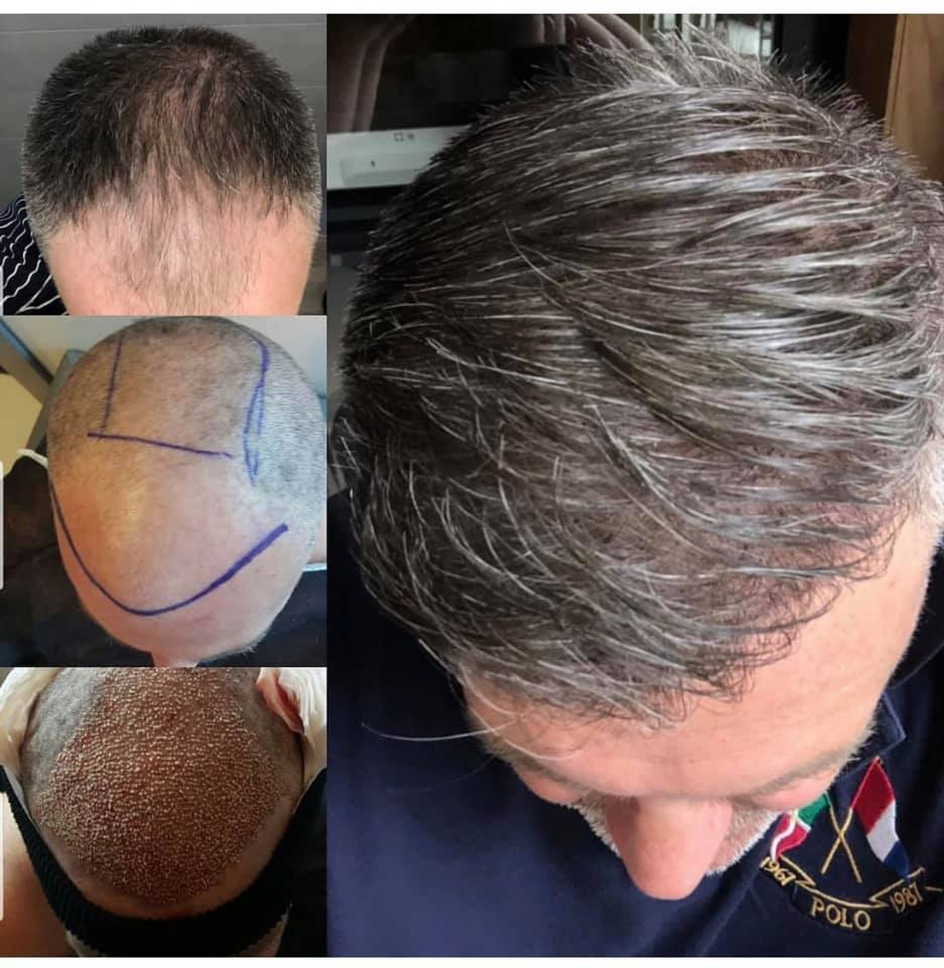 Results of a hair transplant in Istanbul at Estethica Clinic