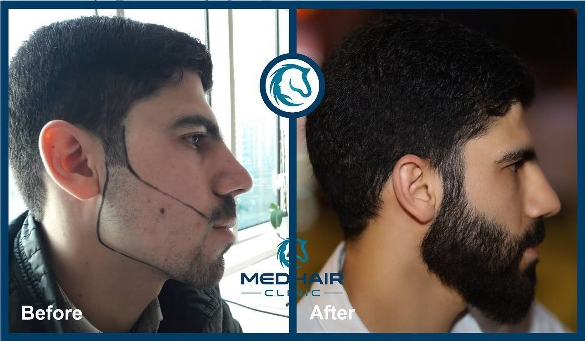Hair transplants for beards in Turkey