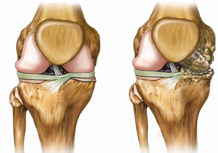 Mesenchymal stem cell therapy for knee osteoarthritis