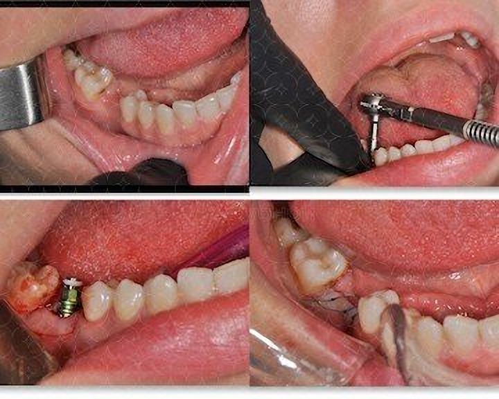 Dental Implant Installation at Your Dental Clinic in Odessa Ukraine