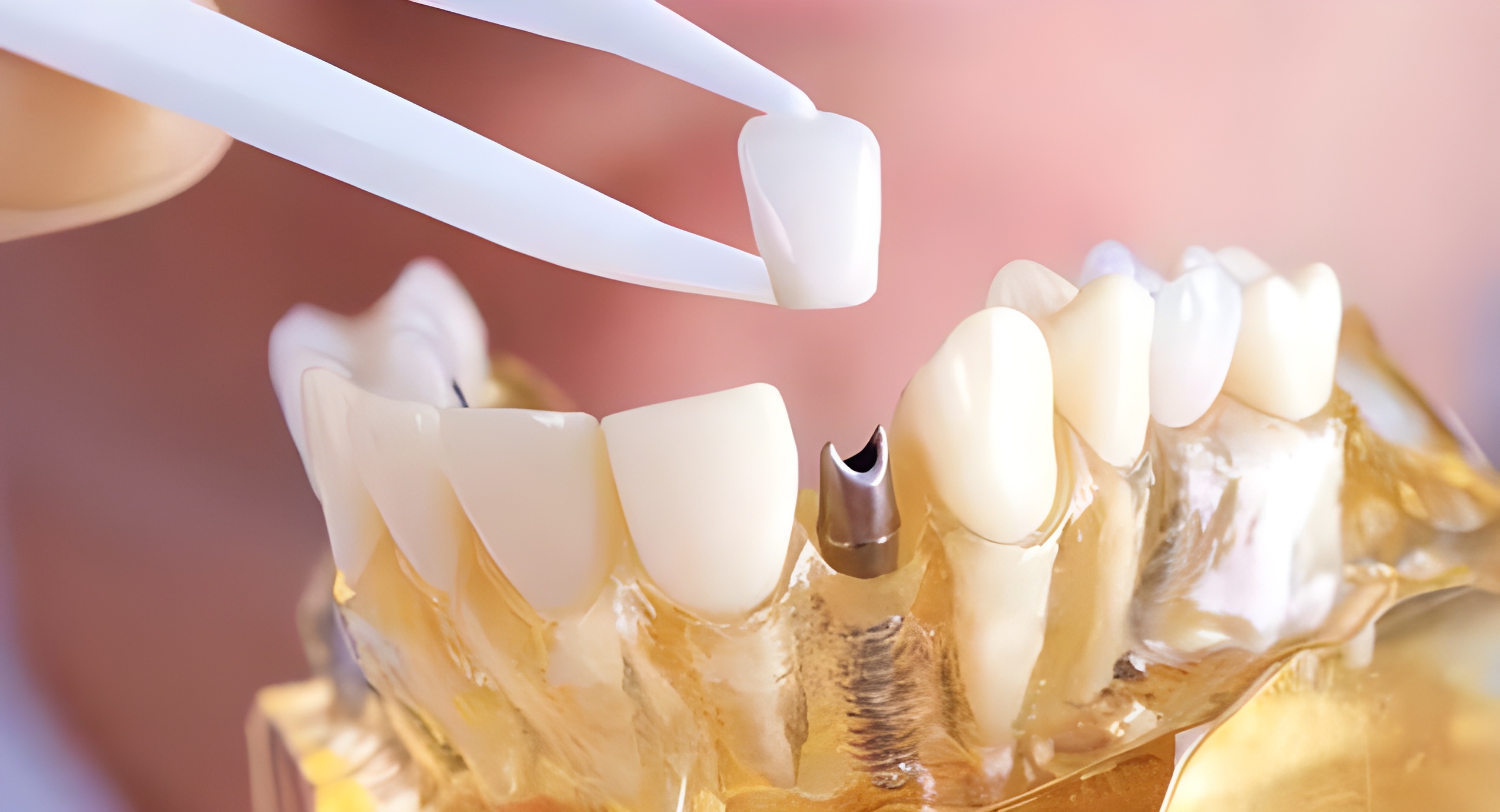Dental crowns: main types of crowns