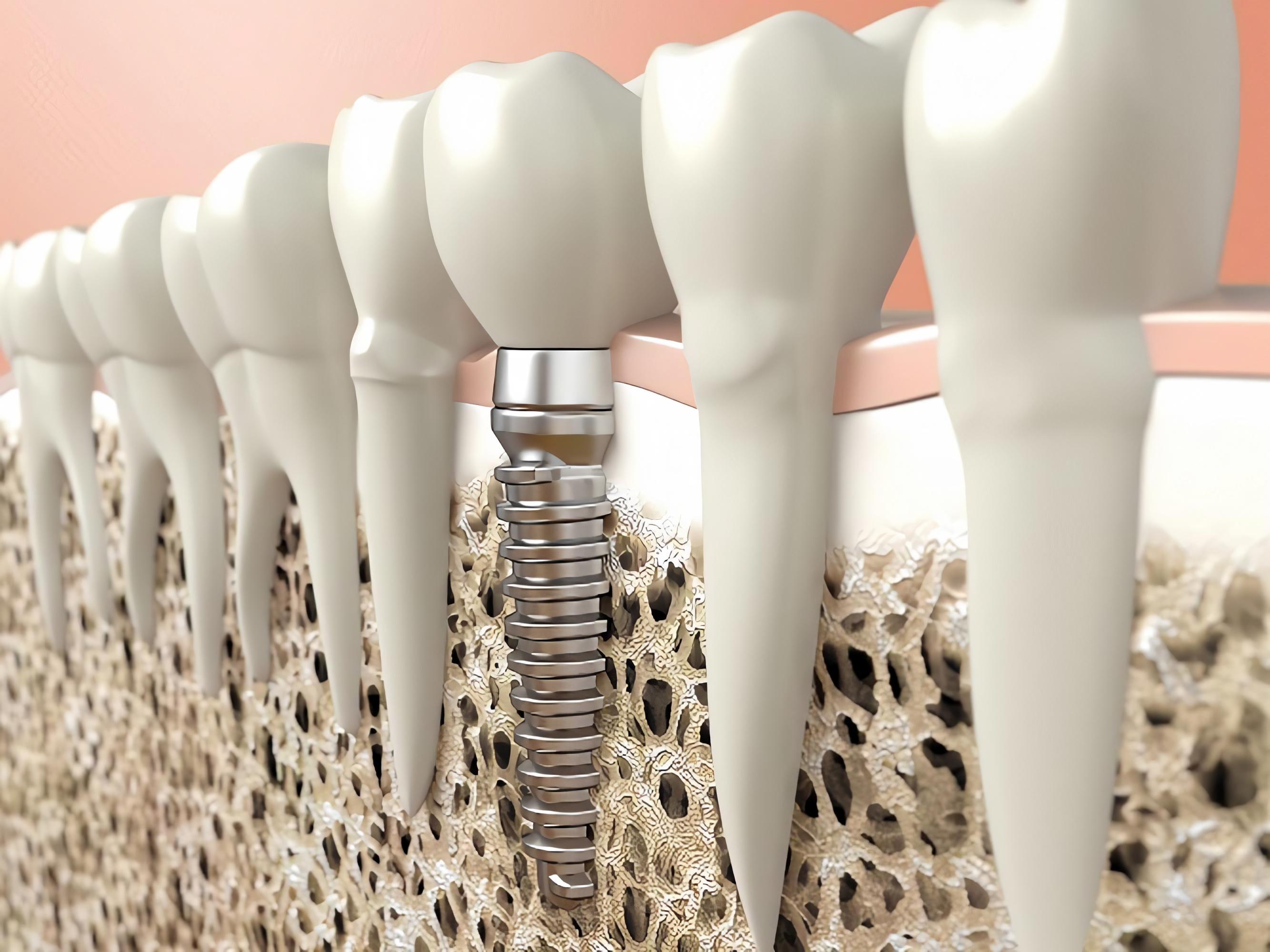 Can you have teeth implants with osteoporosis