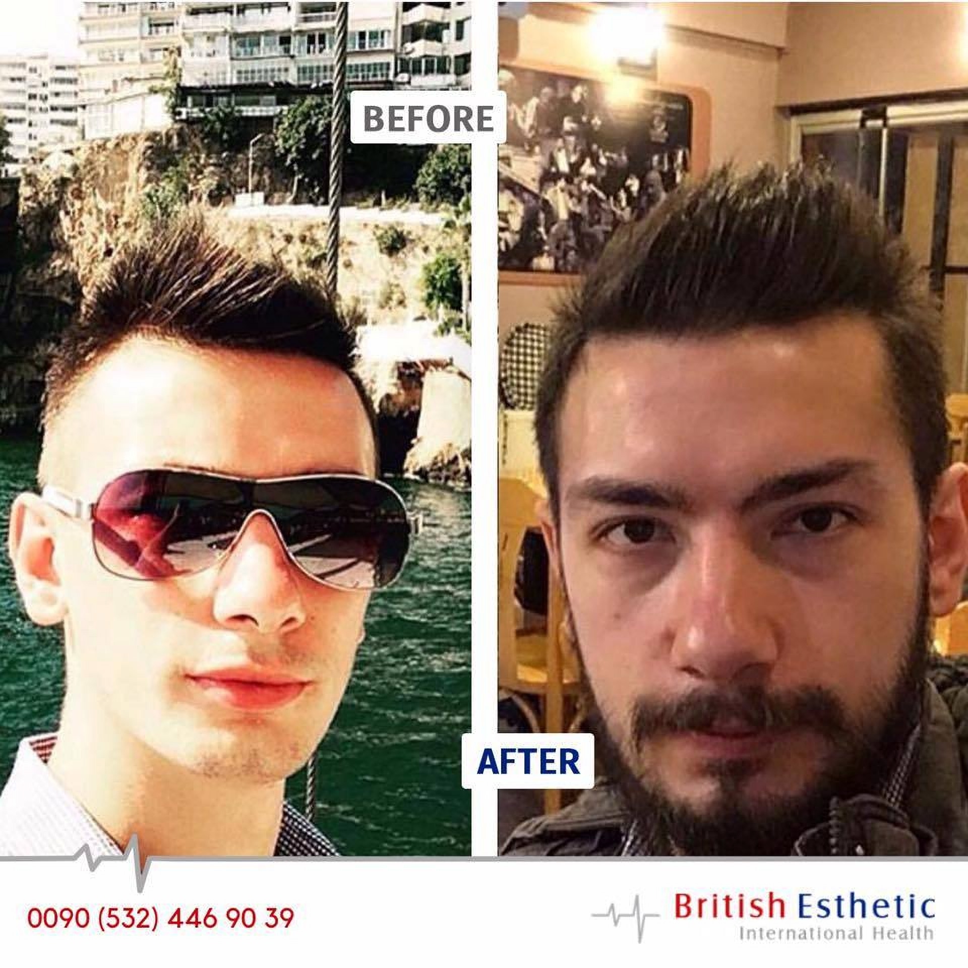 Hair and beard transplants at British Estetik in Istanbul