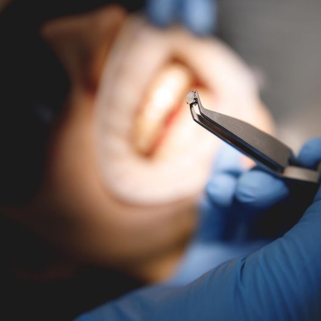 Implants in Dentistry DGclinic Kharkov Ukraine